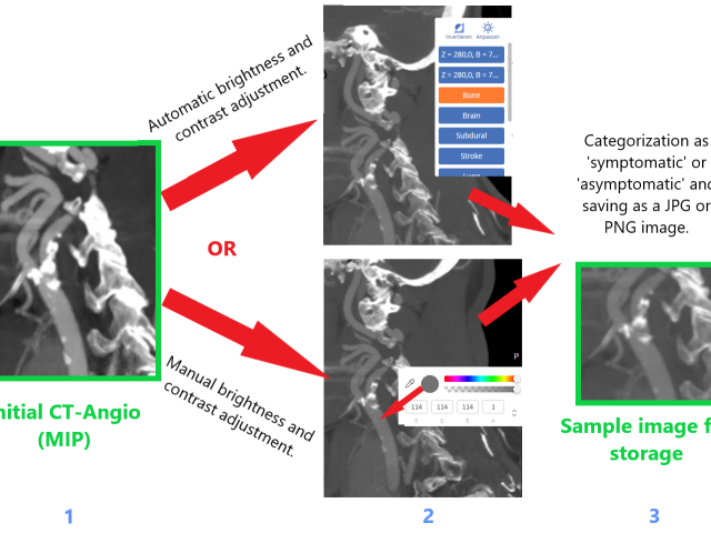 Prediction of asymptomatic, symptomatic carotid stenosis. Full dataset preview