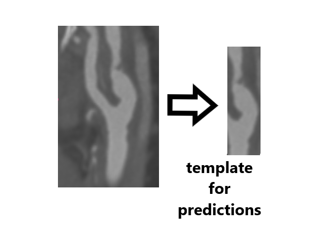 Carote_ML: Prediction of symptomatic, asymptomatic ICA stenosis preview